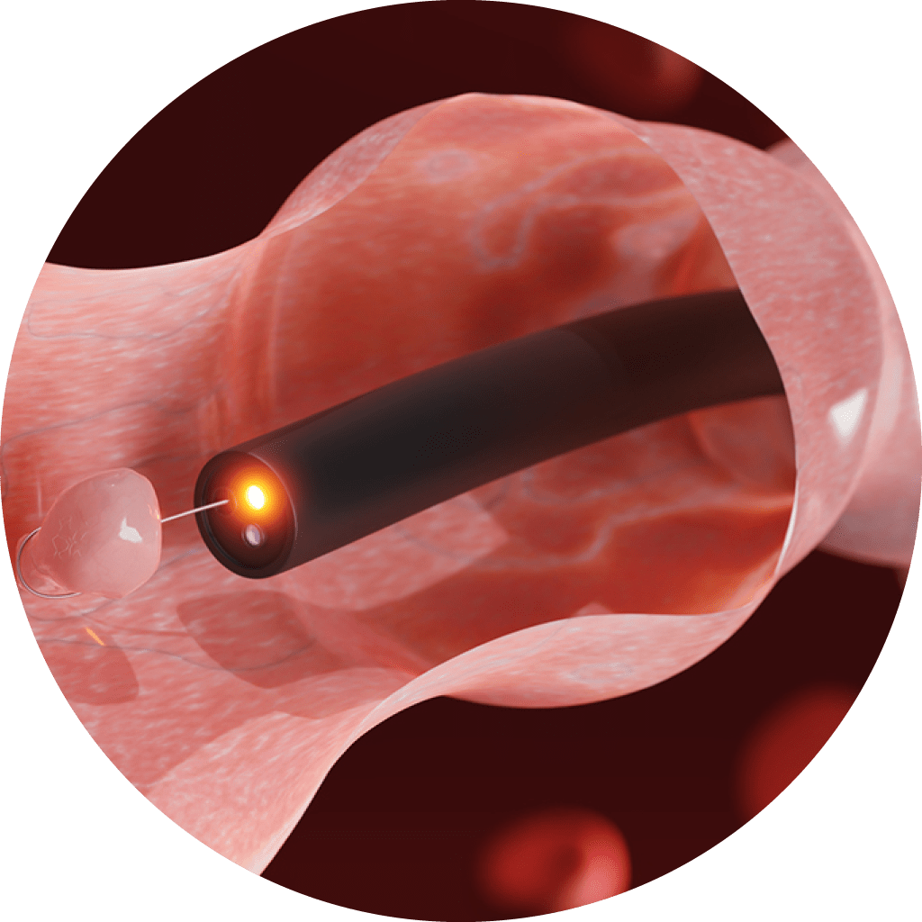 大腸ポリープは内視鏡検査による早期発見がカギです