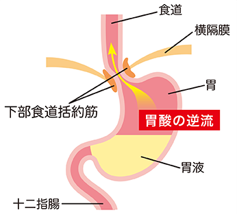 日本橋・東日本橋・久松町まつうらクリニック・胃酸の逆流が起こる理由